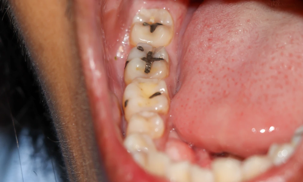 Why Family Dentistry Plays A Vital Role In Preventing Tooth Decay